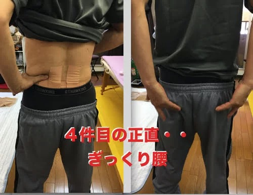 腰痛-ぎっくり腰の治療-整体で治った