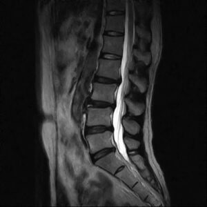 ヘルニア治療-検査画像１