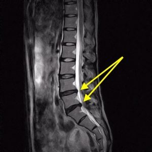 ヘルニア治療-検査画像２