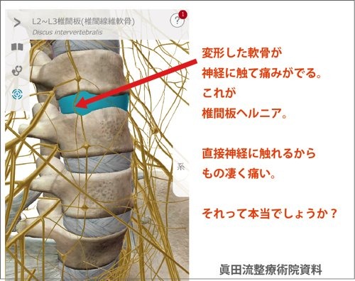 ヘルニアの原因解説2