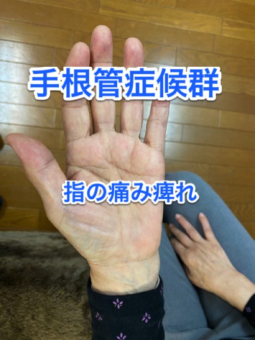 手根管症候群タイトル画像