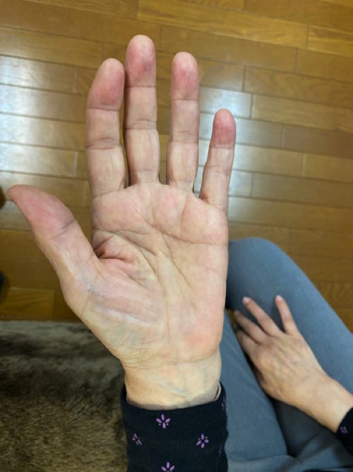手根管症候群の左手