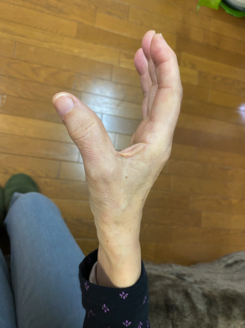 手根管症候群の右手