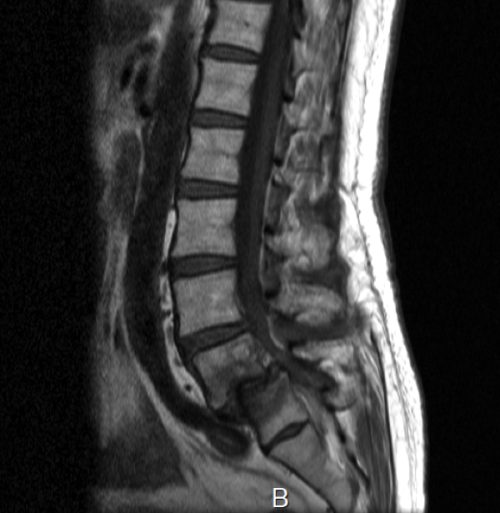 すべり症のレントゲン写真
