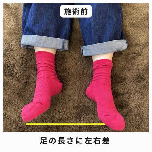 施術前？右足が短い