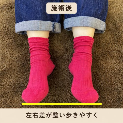 施術後は骨盤の歪みが無くなることで足の左右差が無くなり同じ長さになった