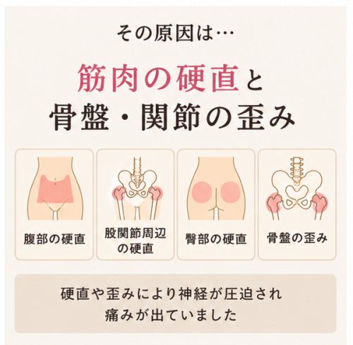 筋肉の硬直と骨盤や関節の歪み＿解説図