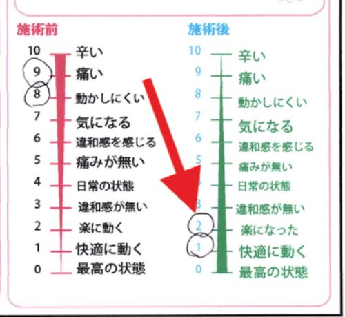 施術後に痛みがなくなった＿グラフ